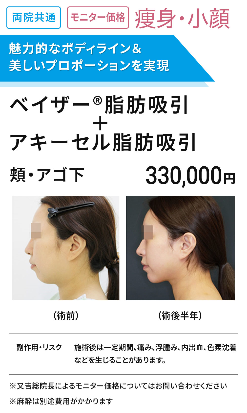 両院共通　ベイザー＋アキーセル脂肪吸引　モニター