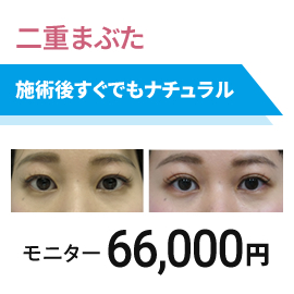 二重まぶた　二重埋没法プレミアムクイック　モニター