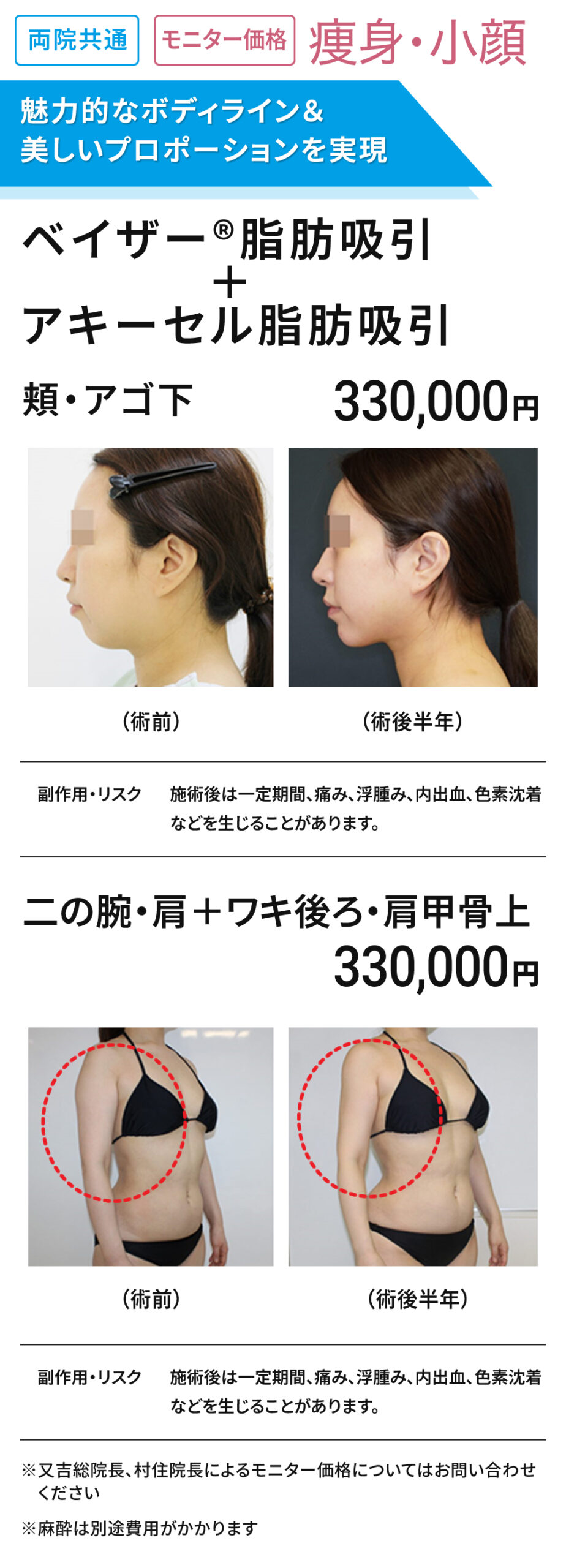 両院共通 モニター募集　痩身、小顔 脂肪吸引
