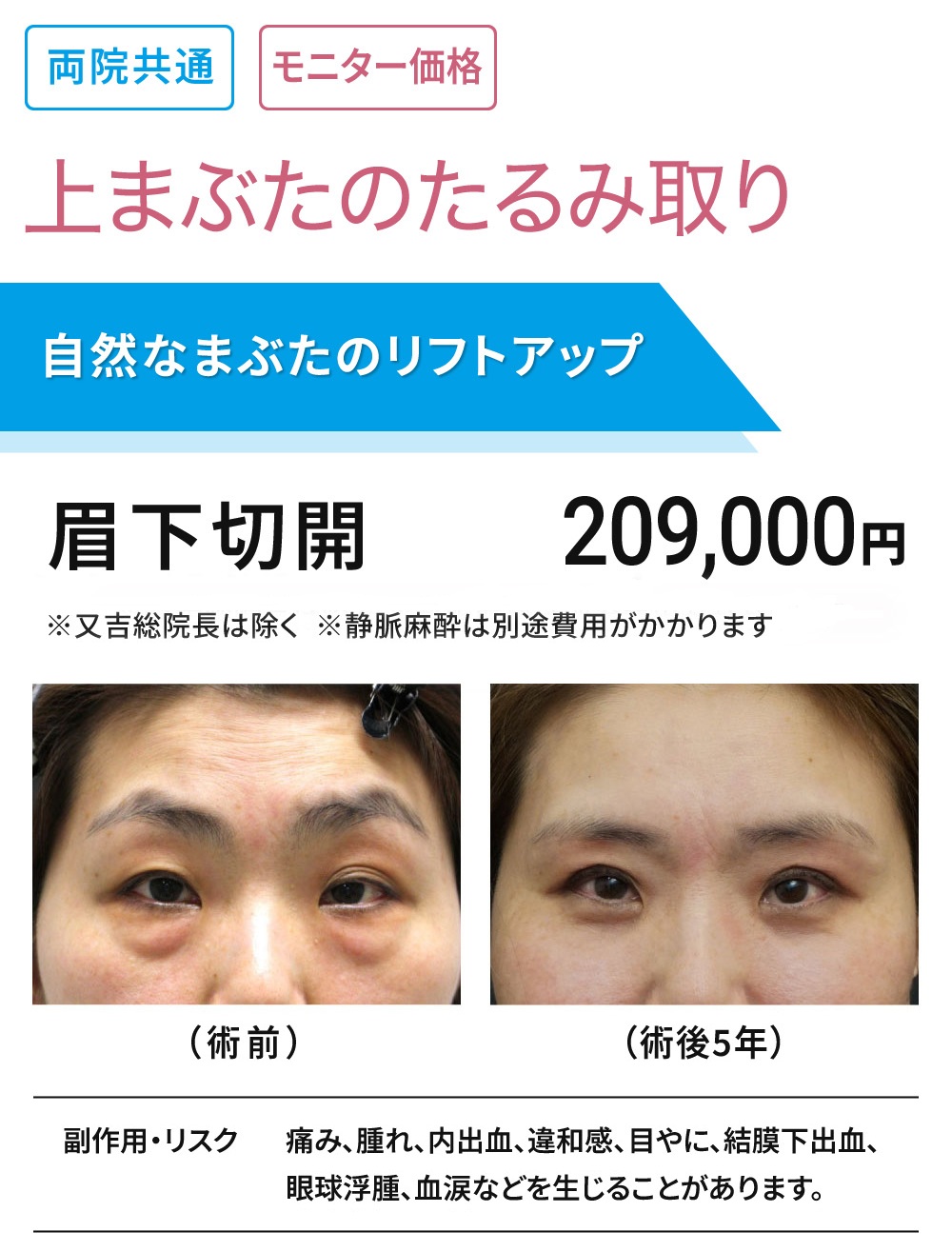 両院共通 モニター募集　上まぶたのたるみ取り