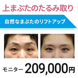 上まぶたのたるみ取り　眉下切開　モニター