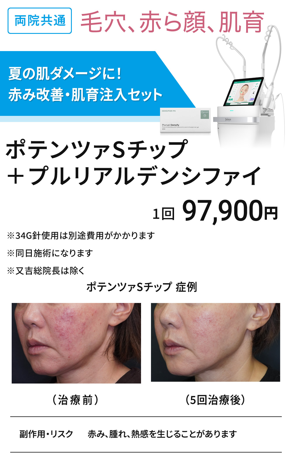 夏のダメージ改善　赤み改善＋美肌注入セット